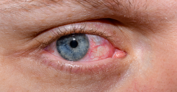 Dry-Eye-Disease-Causes-Symptoms-and-Effective-Treatments-qgskjvqdmrgsxu9eqwtfhyznpa4dtdpaux7lm3twdc Dry-Eye-Disease-Causes-Symptoms-and-Effective-Treatments-qgskjvqdmrgsxu9eqwtfhyznpa4dtdpaux7lm3twdc