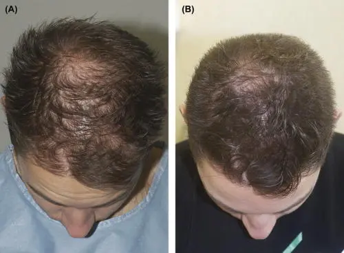PRP-hair-loss-in-man